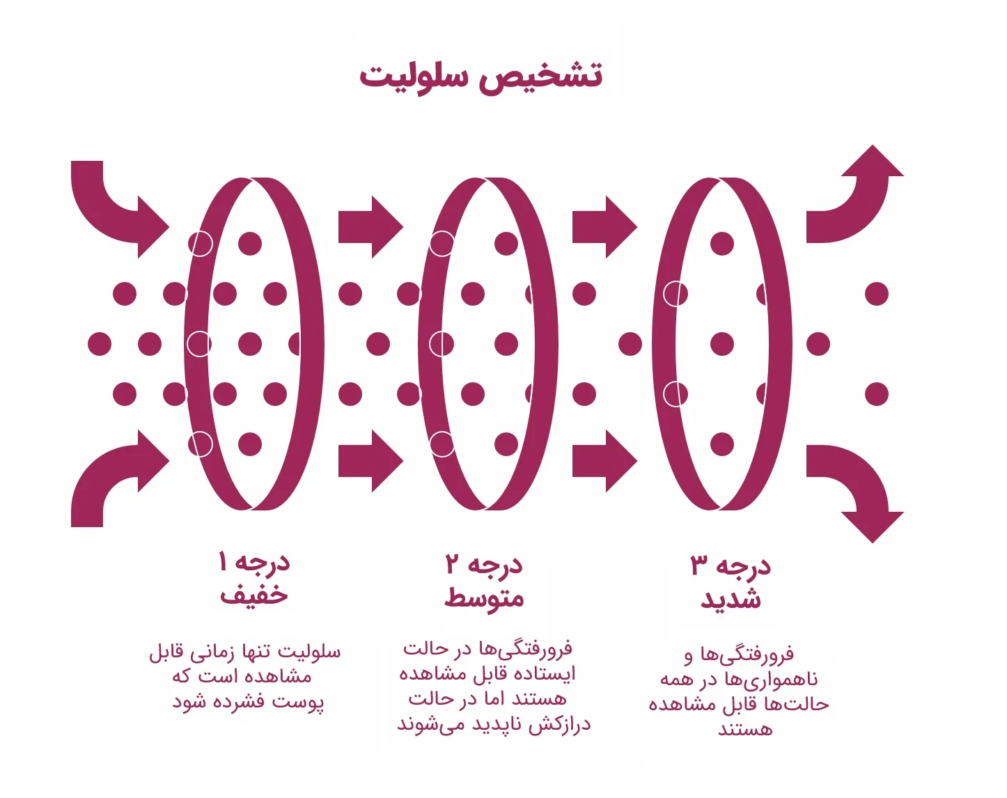 اینفوگرافیک درجه‌بندی شدت سلولیت
